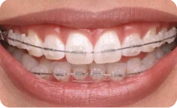 半隐形矫正