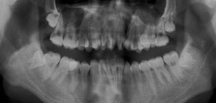 牙列的完整性遭到破坏